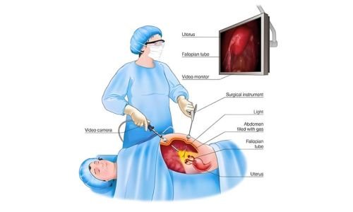 Laparoscopic surgery in gynecology showing camera and instruments